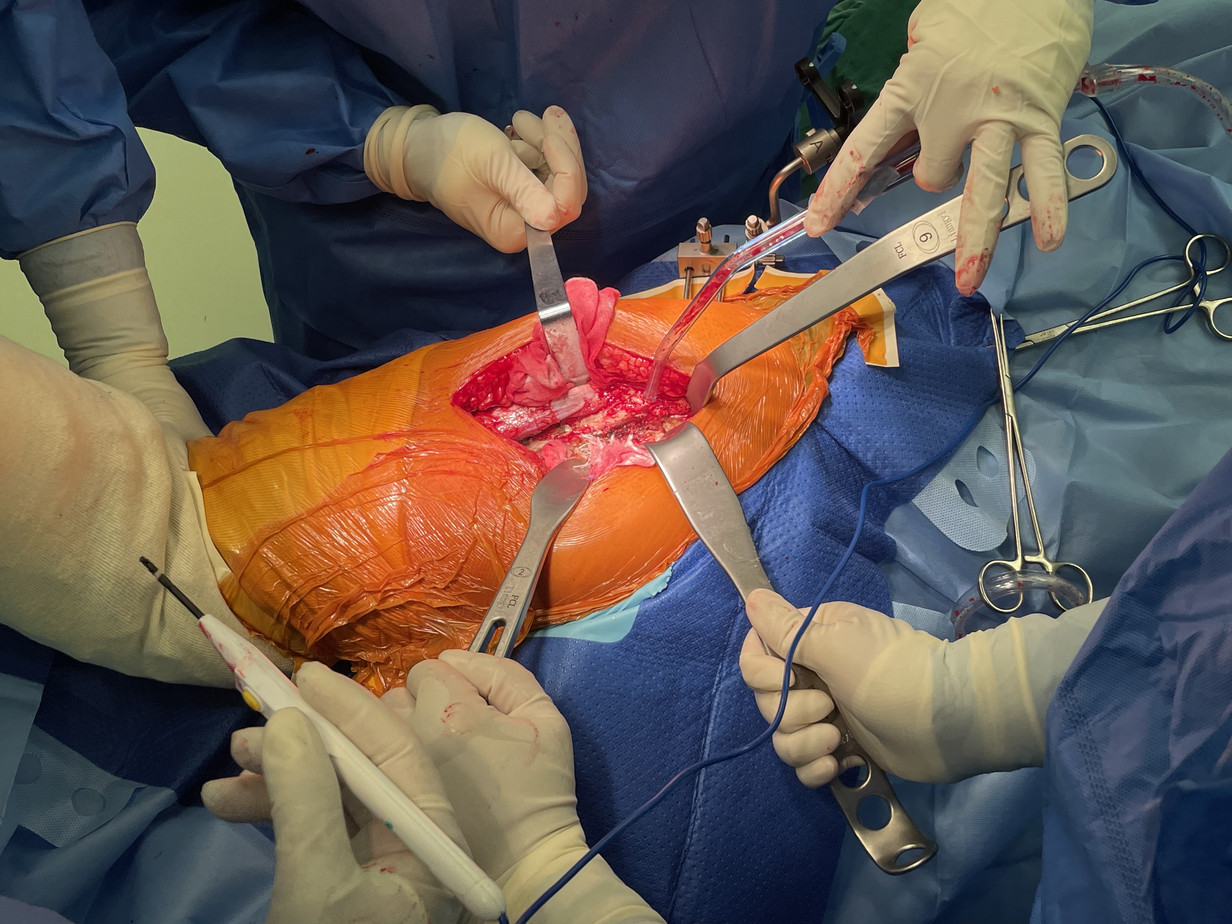 Retractor muscular DAA